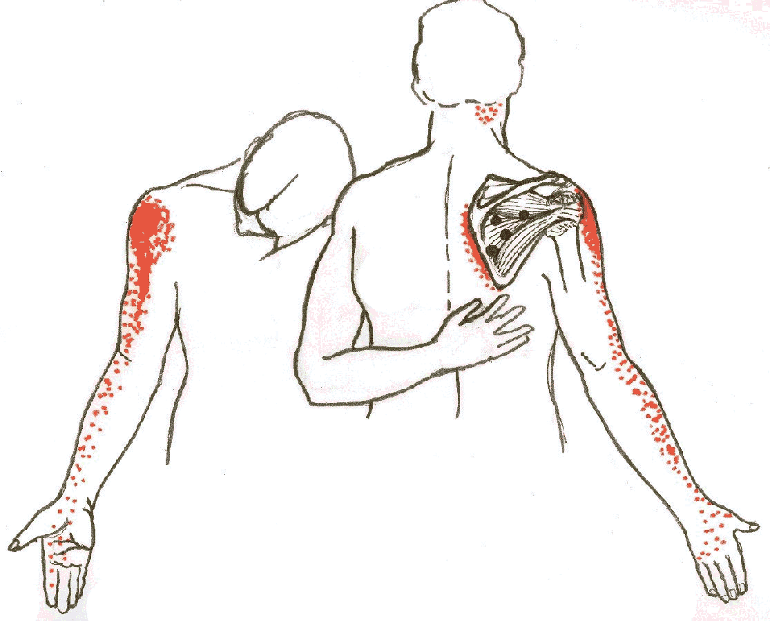 Commonly injured in sudden abrupt arm movements such as catching 