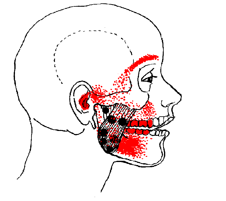 Masseter-Pain-Composite