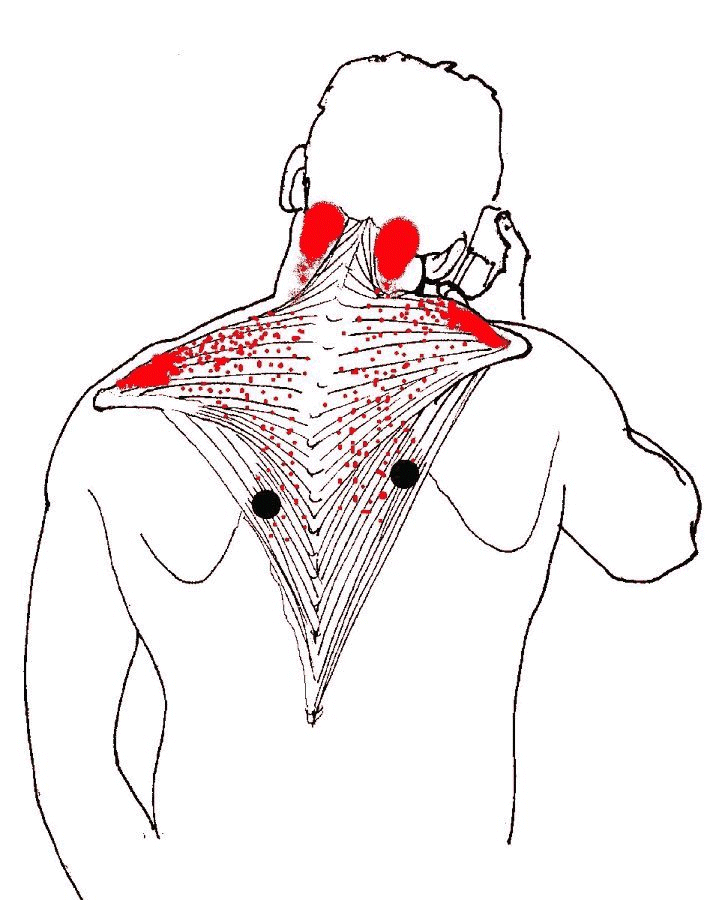 What are the treatments for a pulled trapezius muscle?