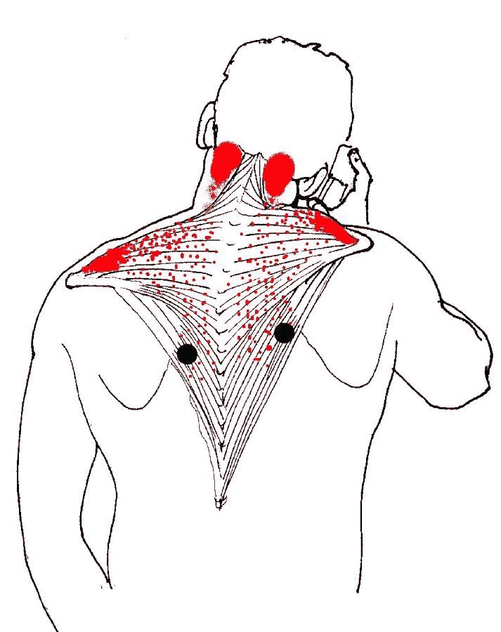 Trapezius muscle pain & trigger points