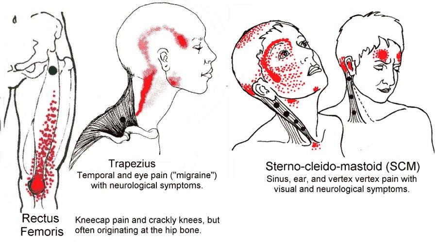 Muscle Pain