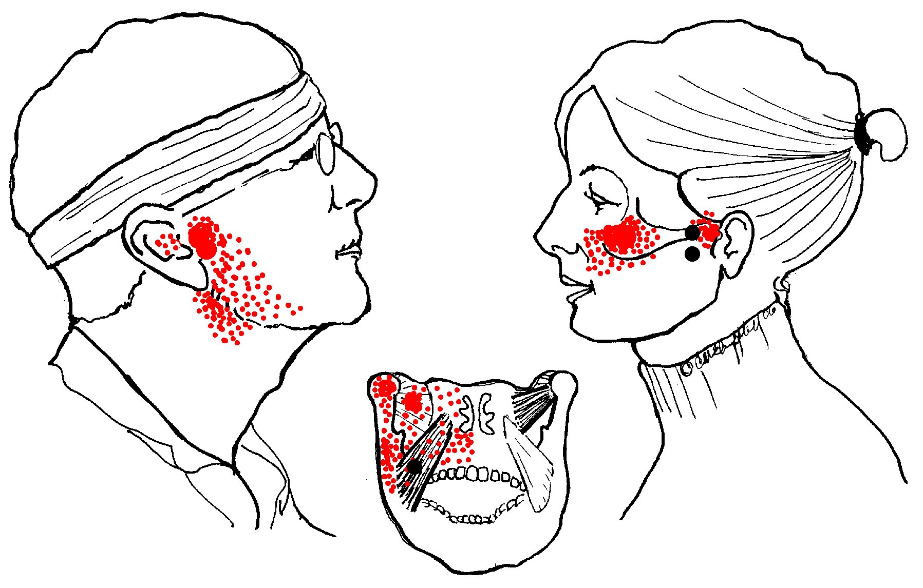 jaw sling