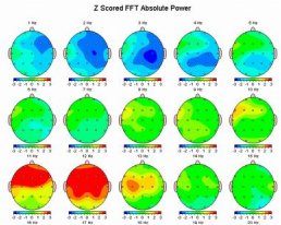 QEEG Sample