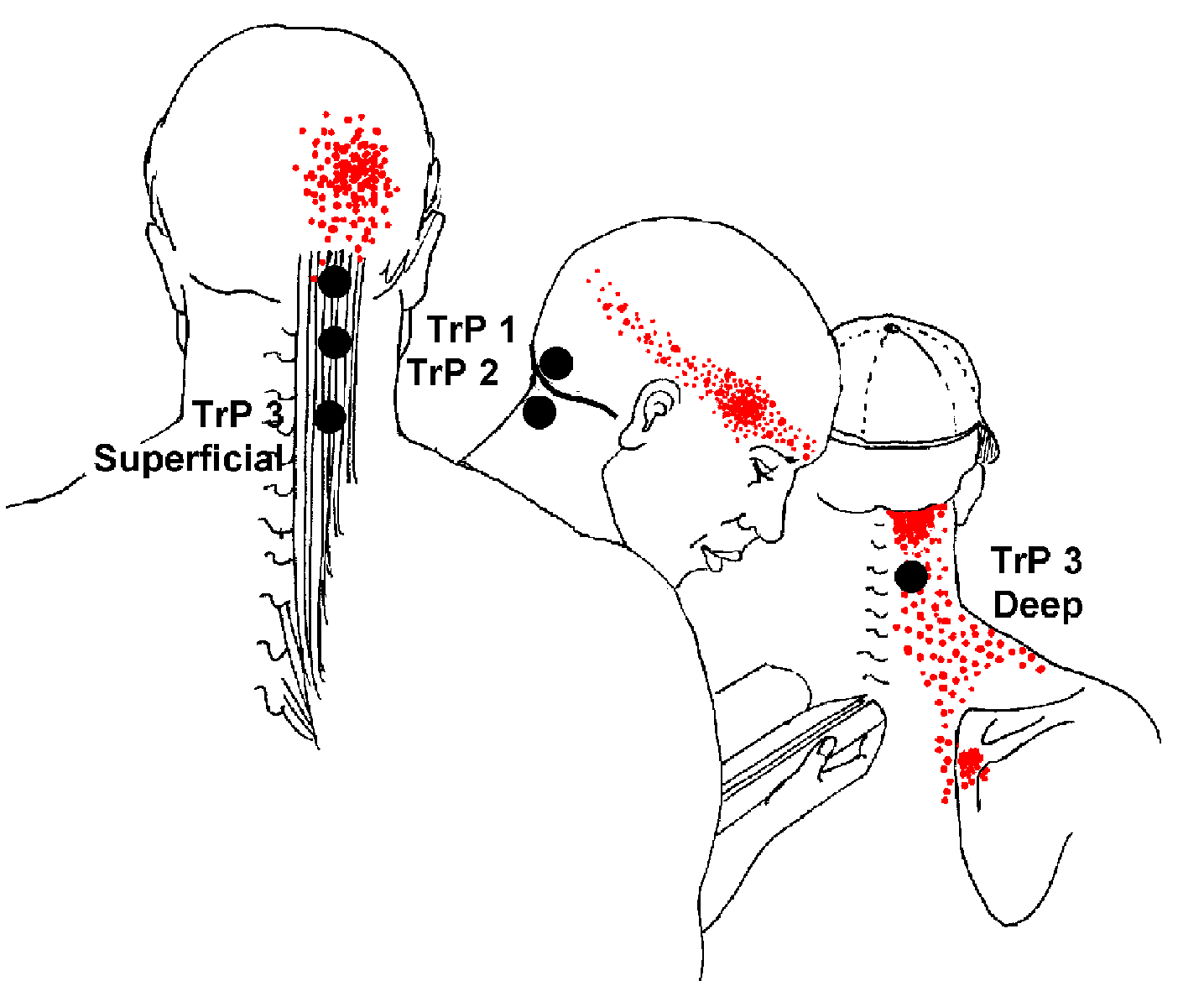Back Head Pain