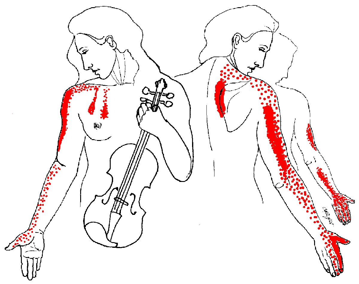 Heart attack pain in right arm
