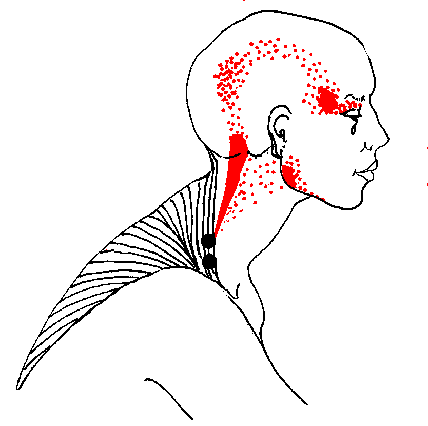 Muscle Trapezius Pain